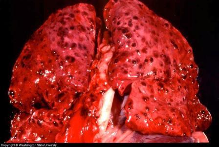 Lung Cancer Staging For Non Small Cell Lung Cancer